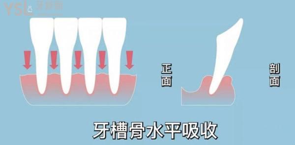 牙槽骨吸收