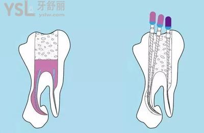 根管治療參考