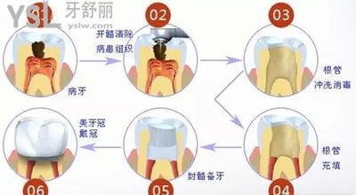 根管治療2