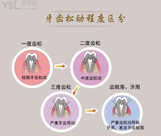 牙齒松動(dòng)程度區(qū)分