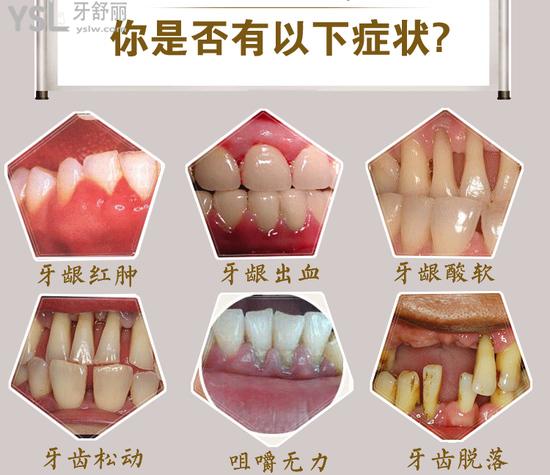 牙齒松動(dòng)牙齦萎縮癥狀