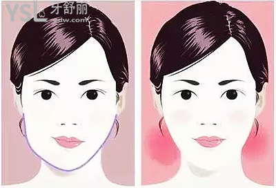 看清26歲矯正牙齒的利與弊