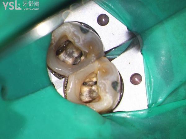 牙齒殘根