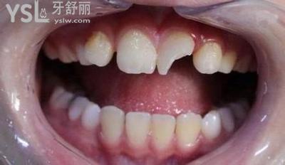 牙掉了