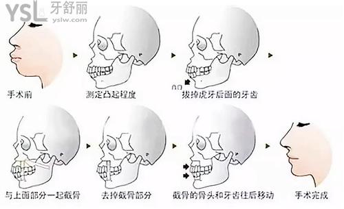 如何判斷正畸還是正頜，正畸和正頜的區(qū)別是什么？來看看