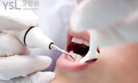 洗牙兩小時后能抽煙嗎