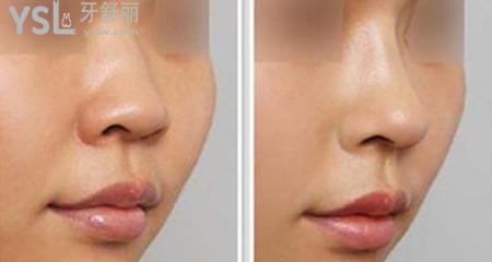 耳軟骨隆鼻手術(shù)**嗎？還需要加假體嗎?