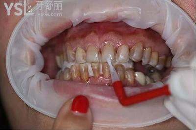 四環(huán)素牙怎么治療成效好（有聲科普）