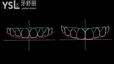 牙齒貼面2