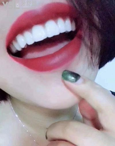 牙齒貼面成效