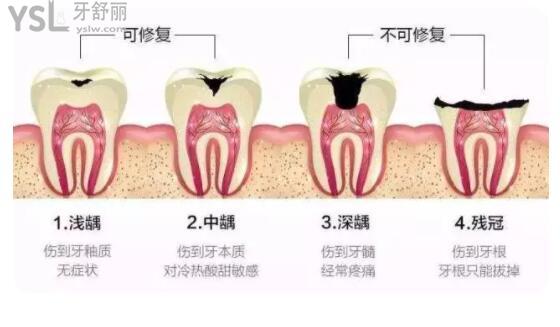 哪些情況需要做根管治療