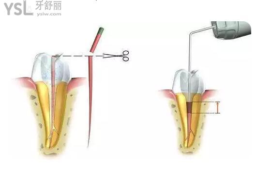 根管治療圖示