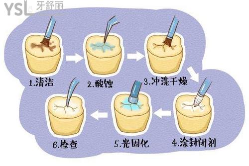補(bǔ)牙的流程及步驟是什么？