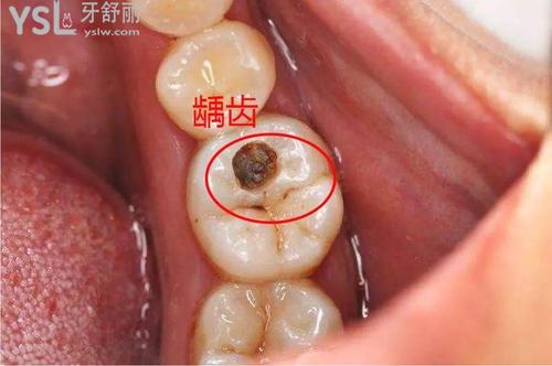 補(bǔ)牙的流程及步驟是什么？過(guò)程超簡(jiǎn)單
