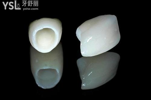 做牙冠保質(zhì)期多久，需要去幾次醫(yī)院？看完你就明白了