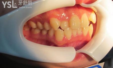 牙齒矯正疼不疼,聽聽別人怎么說?