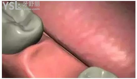 缺牙圖