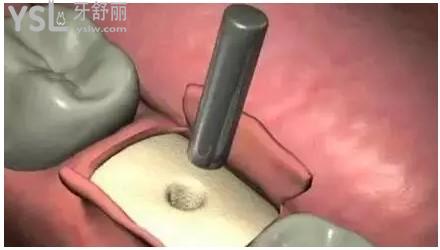 牙槽骨打孔