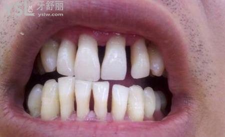 牙齦萎縮之后還能嗎？要怎么做？