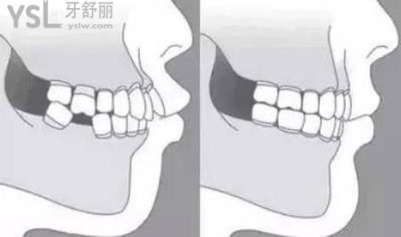 拔牙后過(guò)了一段時(shí)間鄰牙松了是怎么回事？