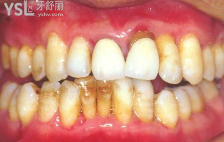 被慢性牙周炎盯上了，有沒(méi)有好的辦法？
