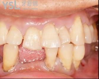 牙自己掉了怎么處理傷口