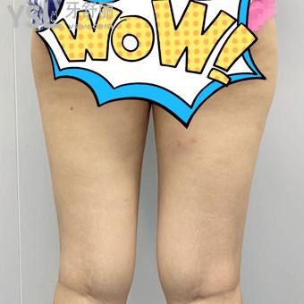 大腿吸脂前