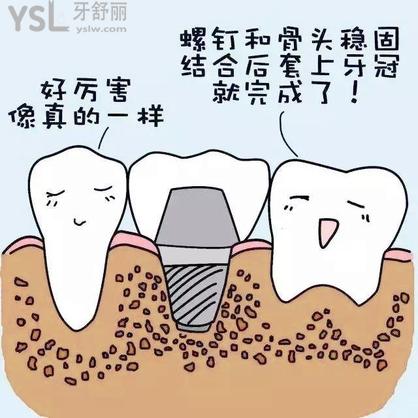 種植牙和真牙一樣嗎？