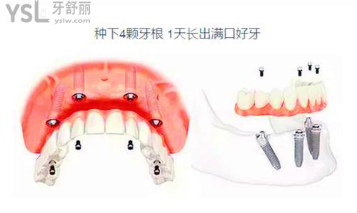 種植牙即拔即種好嗎？2個(gè)因素決定