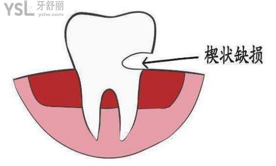 楔狀缺損