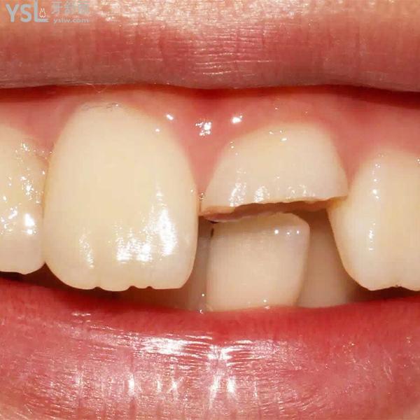 門牙掉了一塊怎么辦怎么修復(fù)？學(xué)會(huì)這些方法就可以