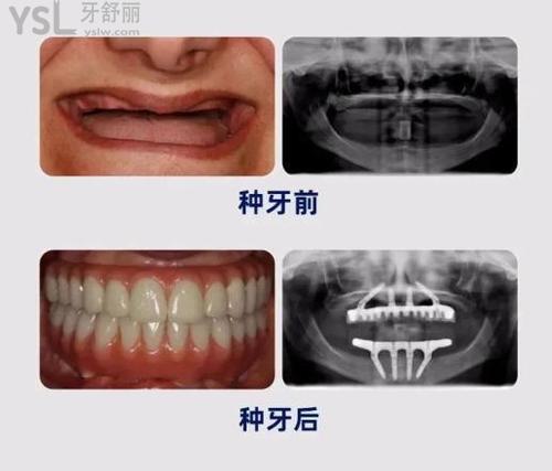 當(dāng)天種牙當(dāng)天用是真的嗎