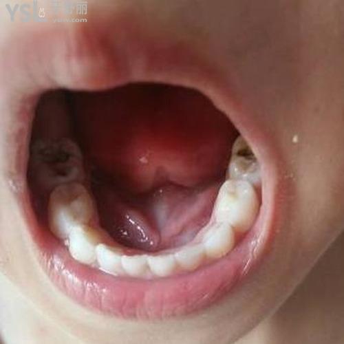 治療蛀牙的方法和步驟有什么注意的？