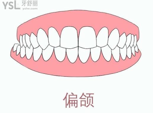 偏頜