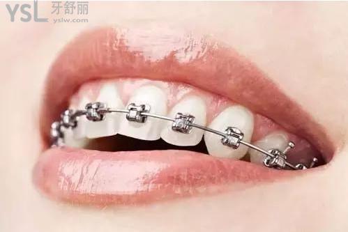 牙齒矯正