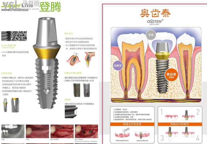 種植牙韓國和歐美的什么區(qū)別