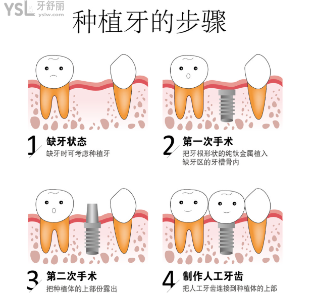 種植牙韓國和歐美的什么區(qū)別