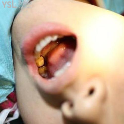 拔牙后頭暈無力是怎么回事？