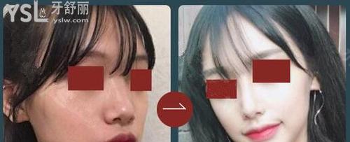 李炳澮院長做鼻子怎么樣2