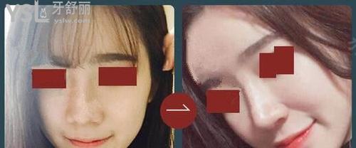 李炳澮院長做鼻子怎么樣1