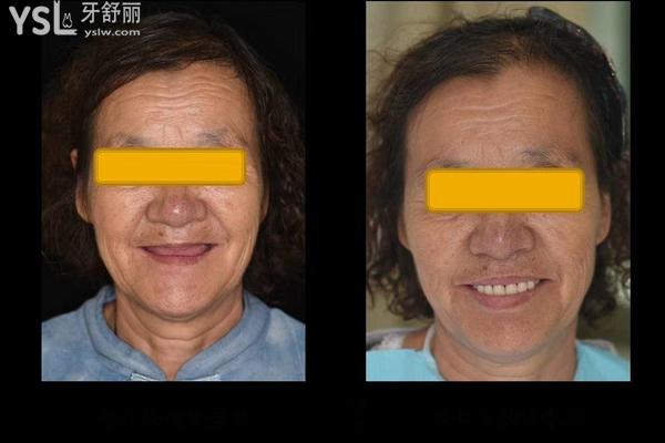 全口無牙怎么種植牙，是一顆一顆嗎？來看答案
