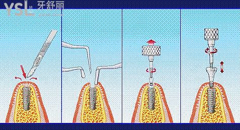 全口無牙怎么種植牙，是一顆一顆嗎？