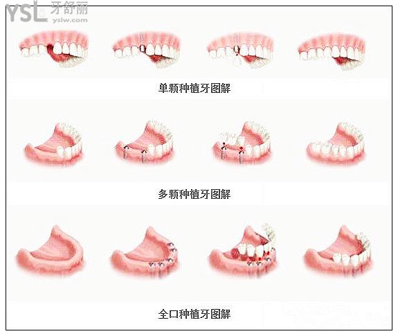 全口無牙怎么種植牙