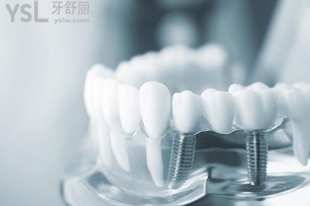種植牙價(jià)格為什么差別那么大，究竟哪種性價(jià)比高？