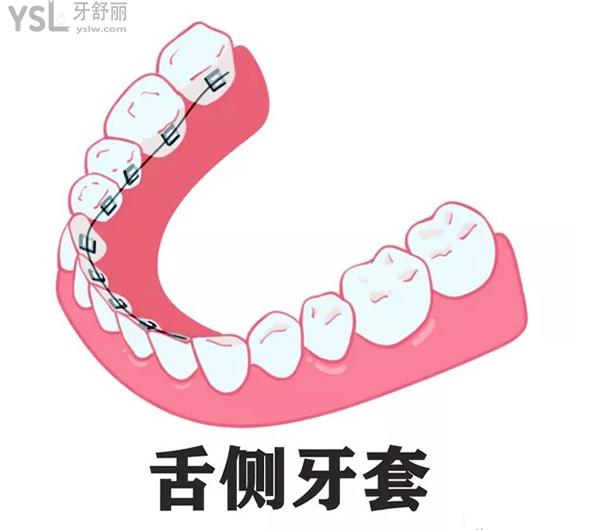 舌側(cè)牙套