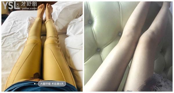 烏魯木齊黎美整形醫(yī)院怎么樣，吸脂好嗎