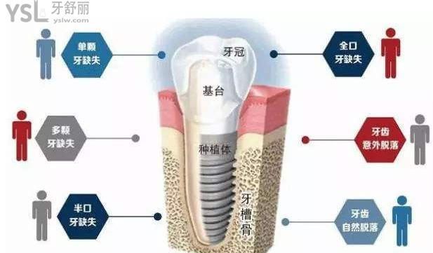 媽媽的牙齒基本快掉完了，想種牙，請問種植28顆牙需要多少錢？