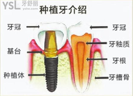 種植28顆牙需要多少錢