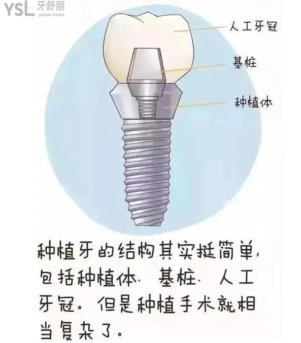 種植28顆牙需要多少錢