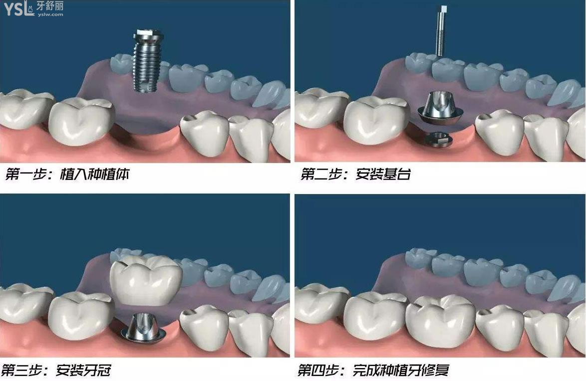 種植28顆牙需要多少錢